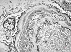 type I membranoproliferative glomerulonephritis